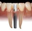 dental implants Las Vegas