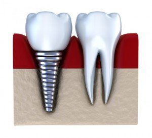 dental implants Las Vegas