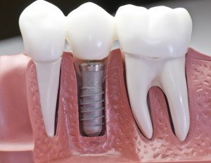 dental implants spring valley nv