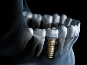 tooth implant las vegas 