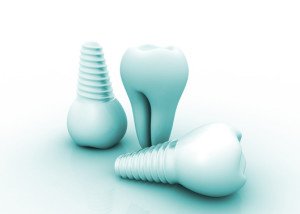 dental implants Spring Valley NV