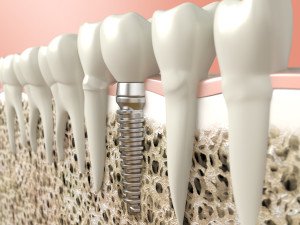 dental implants spring valley nv