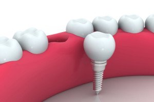 dental implants nevada