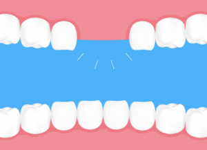 Set of teeth with missing teeth