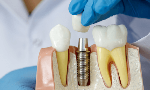 Oral surgeon holding loose dental implant crown of dental implant model