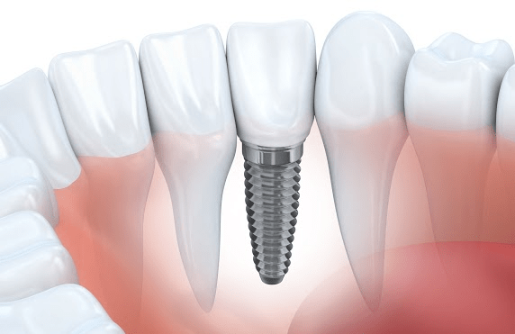 What Is A Bone Graft?