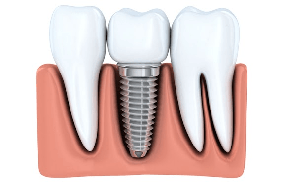 Step-by-Step Guide for Getting a Dental Implant